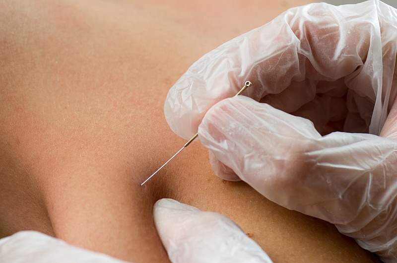 Dry needling